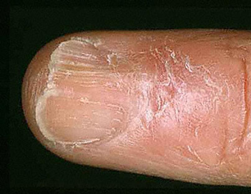 Изменение ногтевых пластин на пальцах рук. Почему слоятся ногти причины лечение. Болезни ногтей на ногах описание и фото. Удаление ногтевой пластины