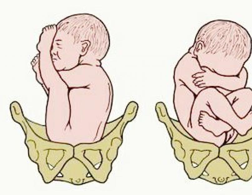 Ребенок расположен справа. Ребенок в тазовом предлежании. Процесс появления детей. Рождение ребенка в тазовом предлежании. Ягодичное предлежание плода.